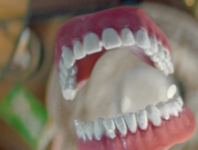 Dentaduras