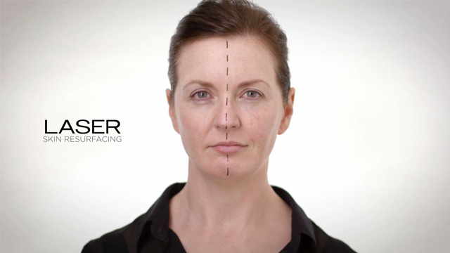 Caso Laser or L´Oreal