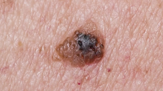 Caso - IBM Outthink Melanoma