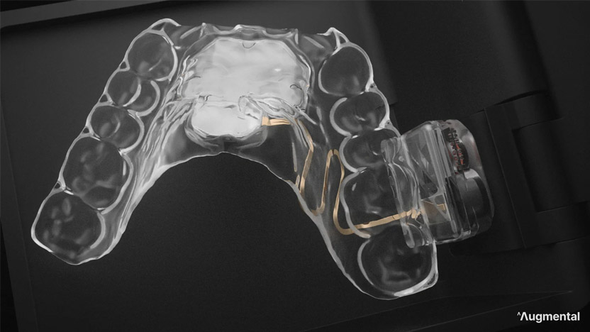 MouthPad 9