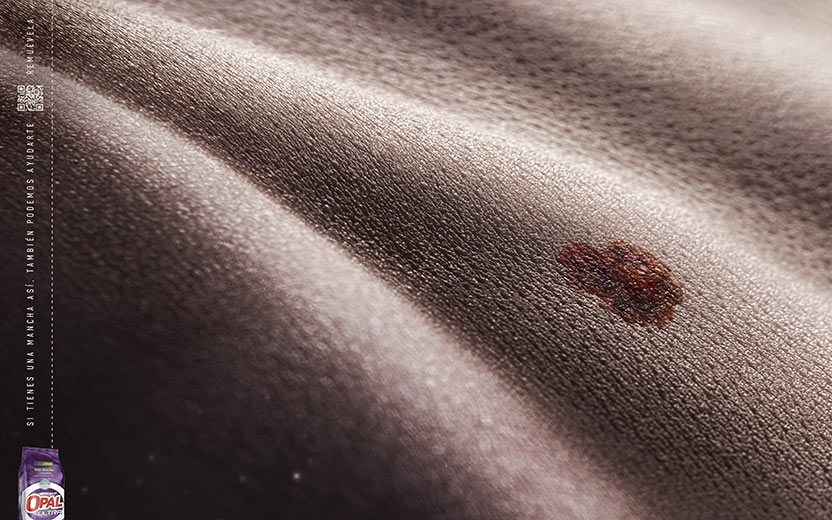 Melanoma 2