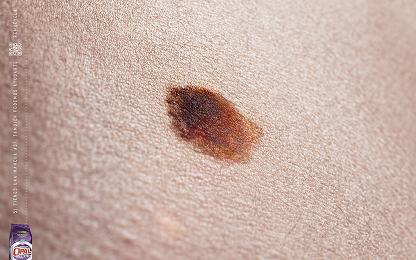 Melanoma 4